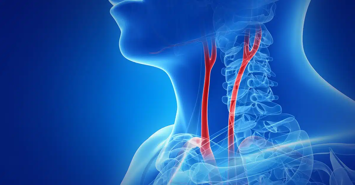 carotid artery
