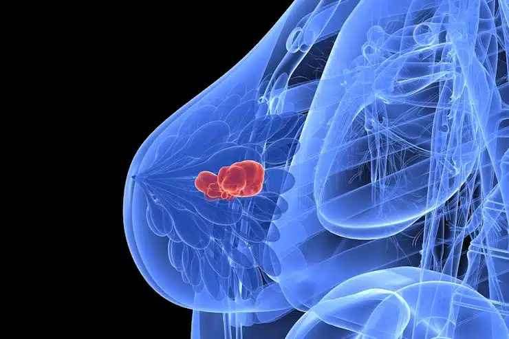 Breast tissue ultrasound