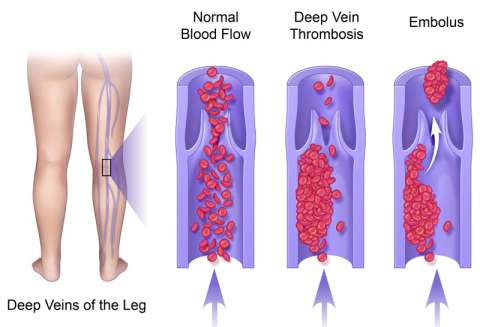 DVT Health Package