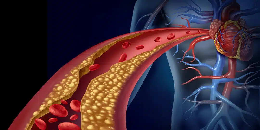 Diagram showing the effects of cholesterol on the vessels