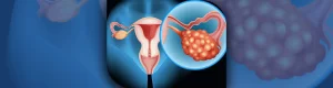 Ovarian Cancer