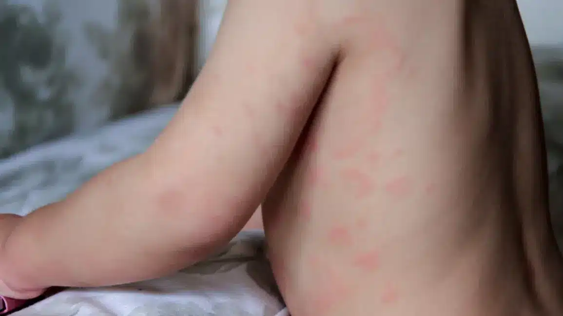 Close-up of red hives and urticaria skin rash on a child's back and arm requiring medical attention
