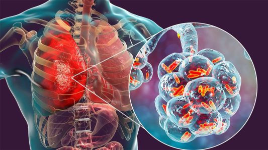 3D medical illustration of inflamed lungs with bacteria close-up, depicting a chest or lung infection