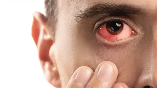 Close-up of a man's red bloodshot eye with fingers nearby, showing signs of eye infection or conjunctivitis